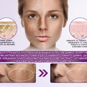 MelantraX – Advanced essence against pigmentation spots