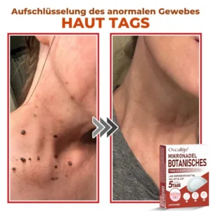 Oveallgo® MicroNeedle PLUS Botanical Day Clear Patch