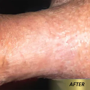 Oveallgo® AHCC Mushroom HPV Genital Warts Eraser Spray