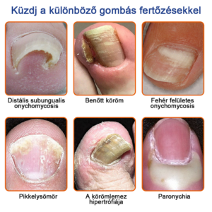 Furzero™ Bee Venom Nail Fungus Treatment Solution