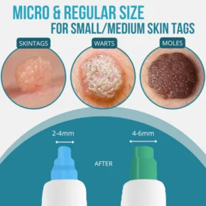 14Pcs Left🔥 | Bikenda® Auto-Micro Skin Tag Remover Kit