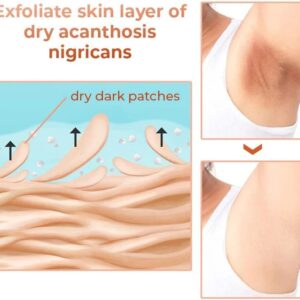 Oveallgo™ Therapy Oil for Acanthosis Nigricans