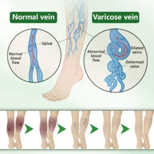 VeinFlex Magnesium Spray for Vein Relief