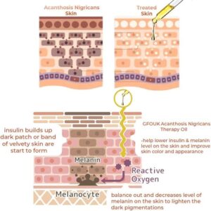 Oveallgo™ Therapy Oil for Acanthosis Nigricans