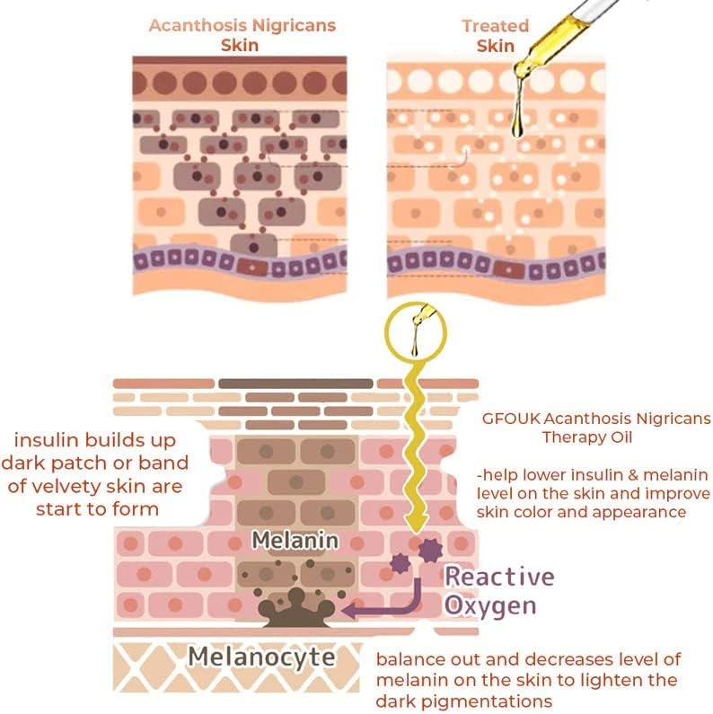 Oveallgo™ Therapy Oil for Acanthosis Nigricans