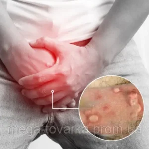 Oveallgo GentX Relief Natural cream HPV, warts, and eczema