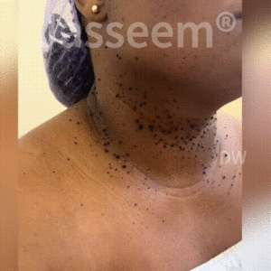 𝐉𝐚𝐬𝐬𝐞𝐞𝐦® 𝐍𝐨𝐧-𝐈𝐧𝐯𝐚𝐬𝐢𝐯𝐞 𝐌𝐨𝐥𝐞 & 𝐖𝐚𝐫𝐭 𝐋𝐚𝐬𝐞𝐫 𝐑𝐞𝐦𝐨𝐯𝐚𝐥 𝐏𝐞𝐧