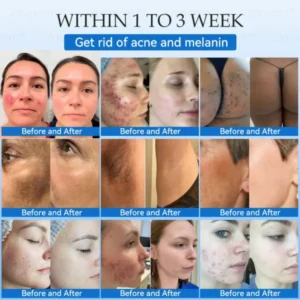 𝐉𝐚𝐬𝐬𝐞𝐞𝐦® 𝐍𝐨𝐧-𝐈𝐧𝐯𝐚𝐬𝐢𝐯𝐞 𝐌𝐨𝐥𝐞 & 𝐖𝐚𝐫𝐭 𝐋𝐚𝐬𝐞𝐫 𝐑𝐞𝐦𝐨𝐯𝐚𝐥 𝐏𝐞𝐧