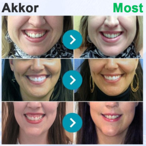 Furzero® Bee Venom Oral Care Powder