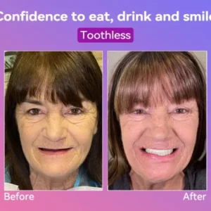 Summer Sale 50% Jasseem® Next-Gen Comfort Denture