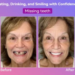 Summer Sale 50% Jasseem® Next-Gen Comfort Denture