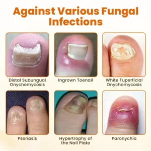 Timilk® FungiBee Advanced Nail Repair Spray