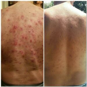 Natural Herbal Formula for Fast, Steroid-Free Relief