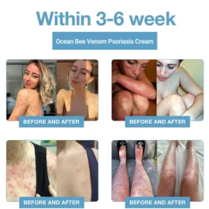 Bee Venom & Ocean Psoriasis Healing Cream
