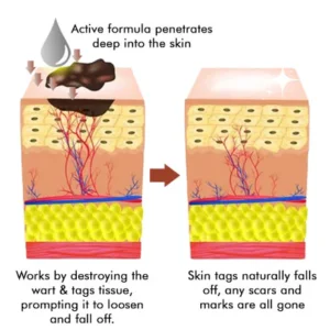 LOVILDS™ Warts & Tags Remover Pen