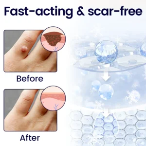 WartFreez Cryo Wart Removal Spray