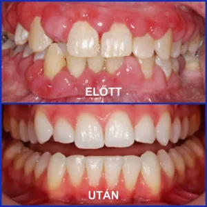 Furzero® Oral hygiene powder with bee venom