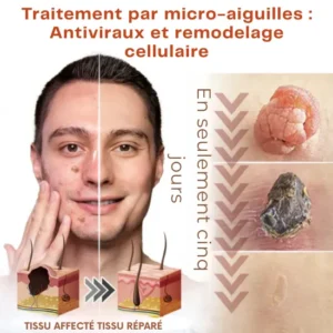 microneedle skin tag patch