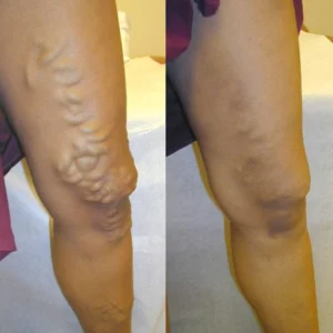 Herbal Varicose Vein Relief & Leg Comfort Cream