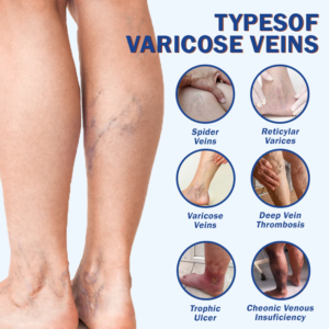 Herbal Varicose Vein Support Capsules – Circulation & Leg Relief