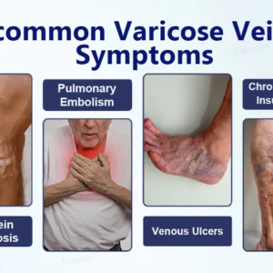 Herbal Varicose Vein Relief & Leg Comfort Cream
