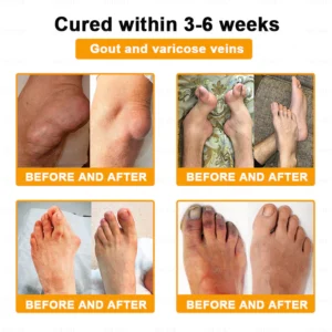 XRLXRL® Bee-Venom Pain-Relief Bone Healing Cream