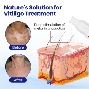 Cvreoz®Vitiligo Treatment Spray