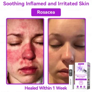 CO2 laser pen for skin care