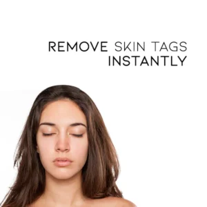 skin tag treatment topical