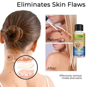 Fivfivgo™ TAGAway solution for removing moles and warts