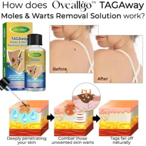 Fivfivgo™ TAGAway solution for removing moles and warts