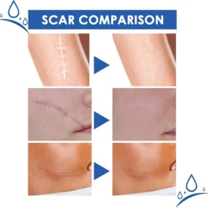 professional scar removal gel