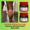Herbal Varicose Vein Relief Cream – Circulation & Leg Comfort Formula