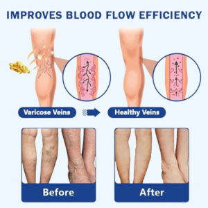 Herbal Varicose Vein Support Capsules – Circulation & Leg Relief