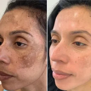 anti-dark spot brightening serum