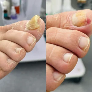 mycomist professional grade anti-fungal spray and oil