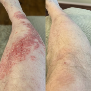 foulme bee venom skin relief cream