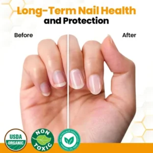 mycomist bee venom formula for yellow damaged nails