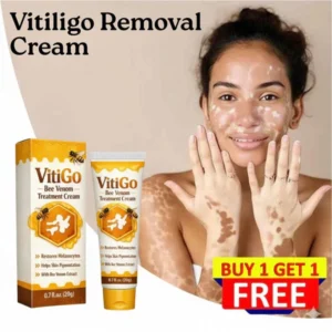 professional vitiligo care with md vitigo restore