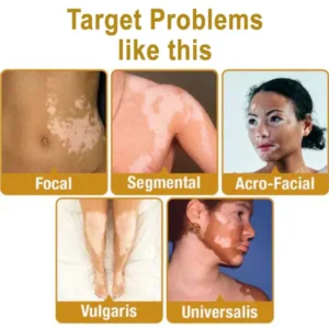 md vitigo advanced formula for vitiligo spots