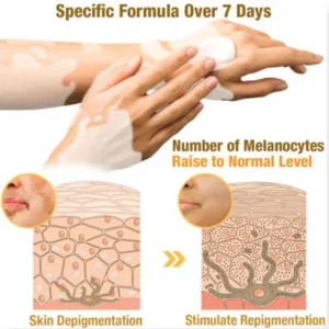 effective pigmentation support with md vitigo