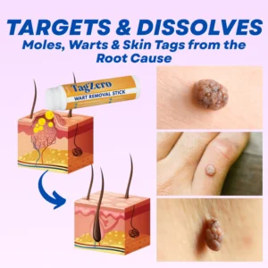 timilk tagzero before and after wart removal
