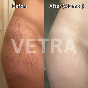 soothing raised scars with vetra silicone formula