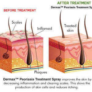 anniecare professional grade psoriasis spray reviews