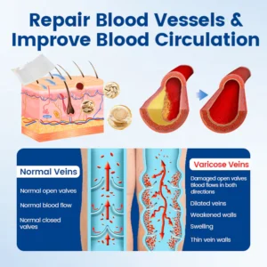 timilk vein ease before and after leg swelling