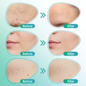 carebreeze 3-in-1 microneedle care patch for results