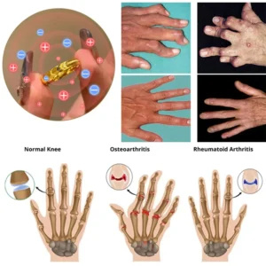 lymphatic cat eye ring before and after swelling reduction
