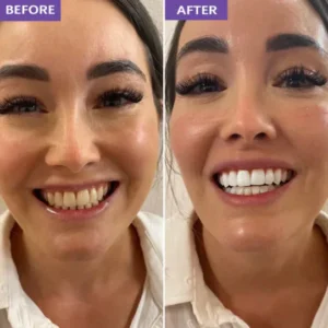 magic white strips before and after whitening