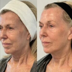 Instant skin lifting serum by DermaLift for fine lines