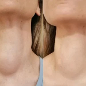 VeinKill Anti-Varicose Vein Patch before and after leg results